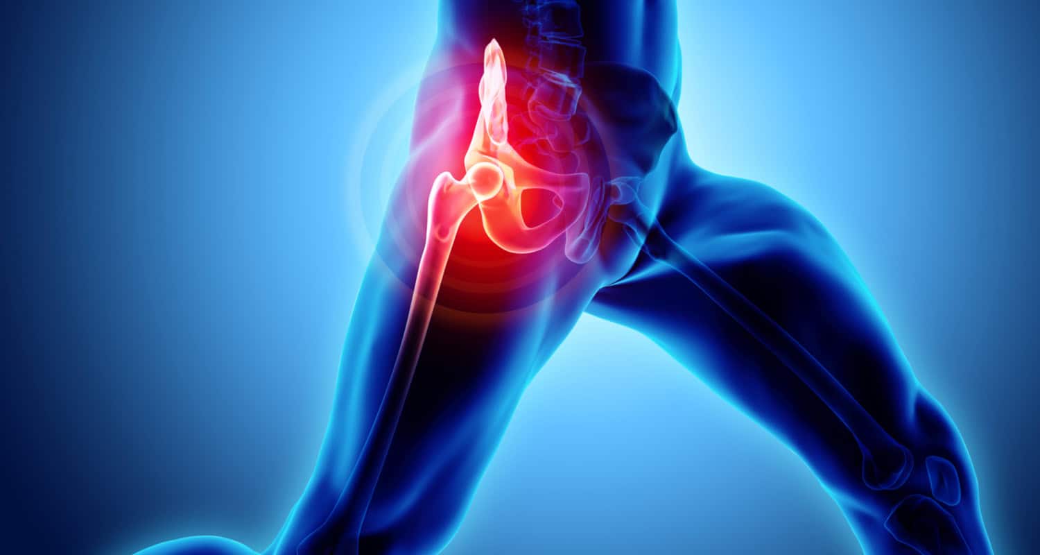 Sciatica and Groin Pain in Females 2